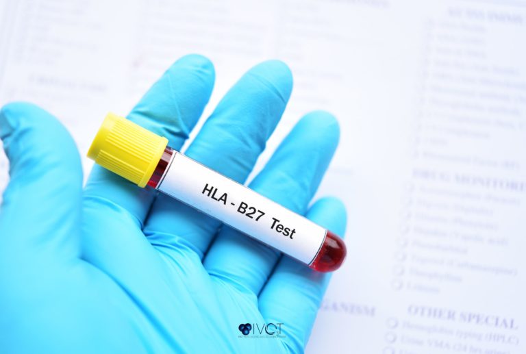 HLA-B27 POSITIVO