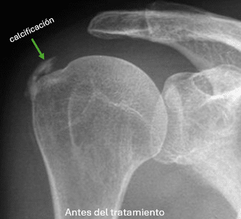 Tendinitis calcificada