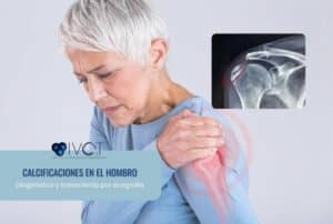 calcificación del hombro