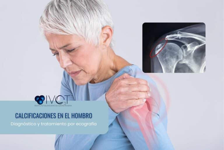 Calcificaciones en el hombro