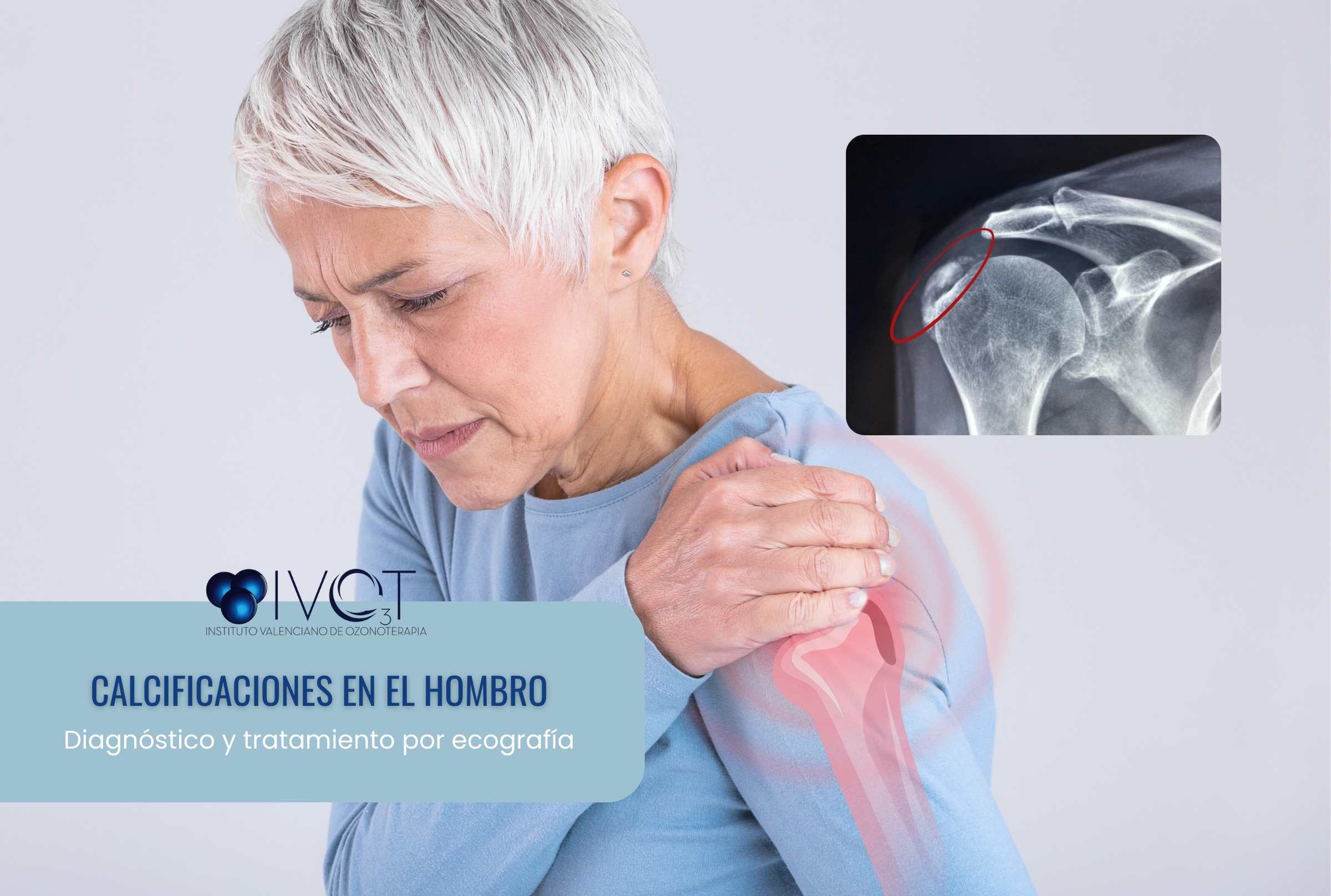 calcificación del hombro