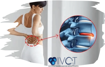 Síntomas según la etapa de la hernia discal lumbar