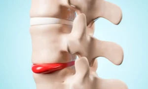 Lee más sobre el artículo Ozonoterapia para hernia discal: cómo funciona y cuándo está indicada